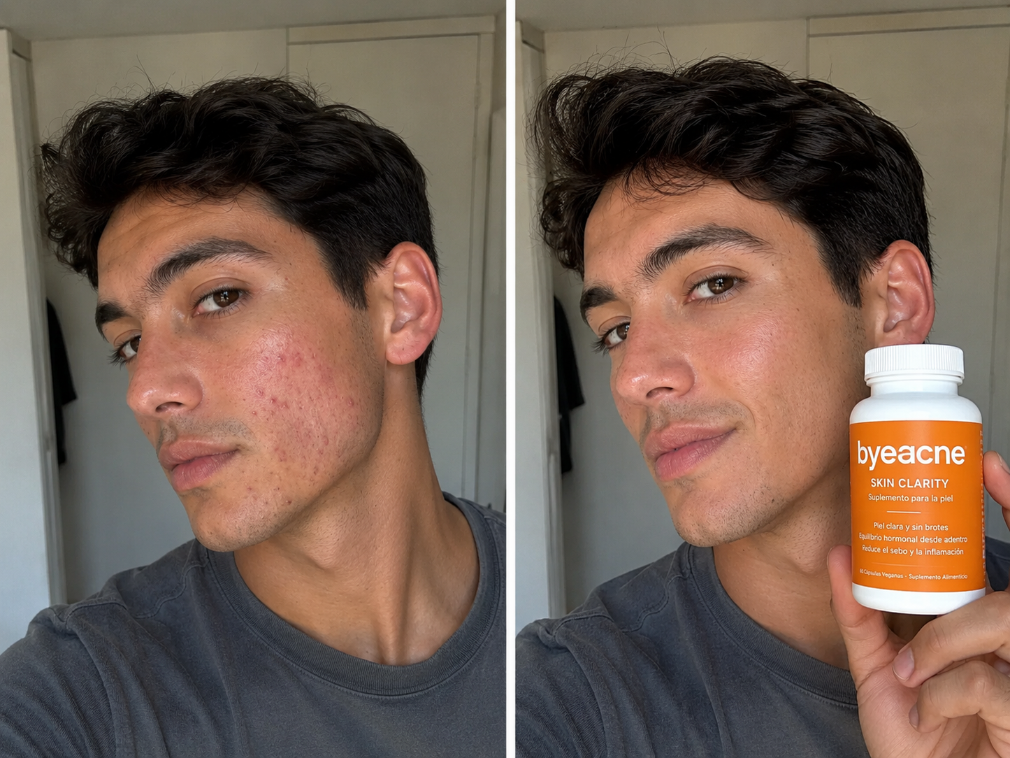 Byeacne® - Volvé a mostrar tu piel sin esconderte